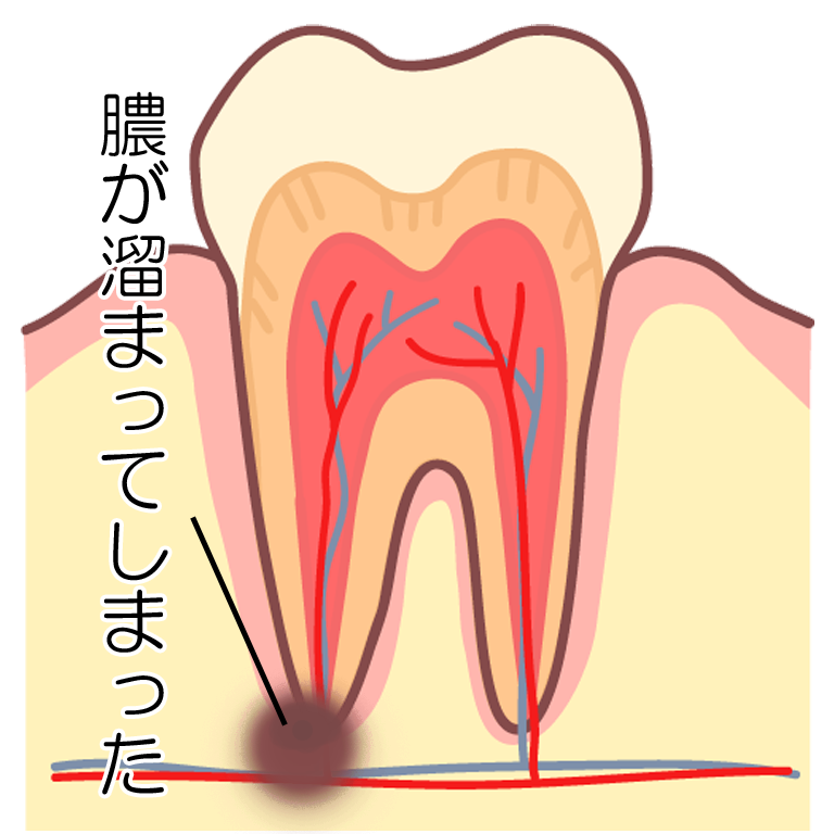 歯根嚢胞